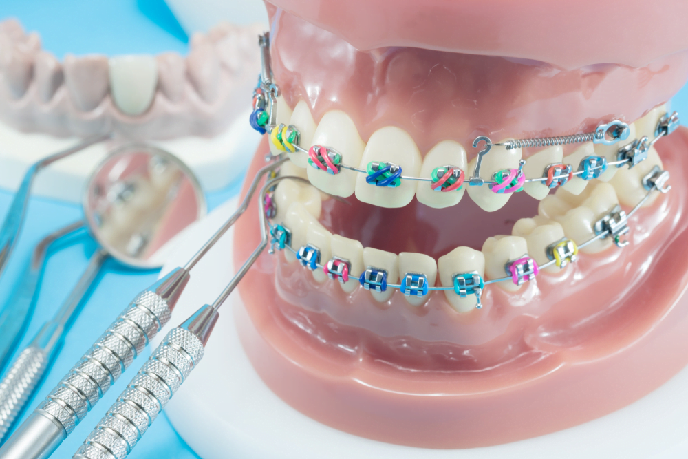 ‘Wearing Braces Without A Medical Necessity Can Lead to Oral Health Problems’ – Orthodontist Warns